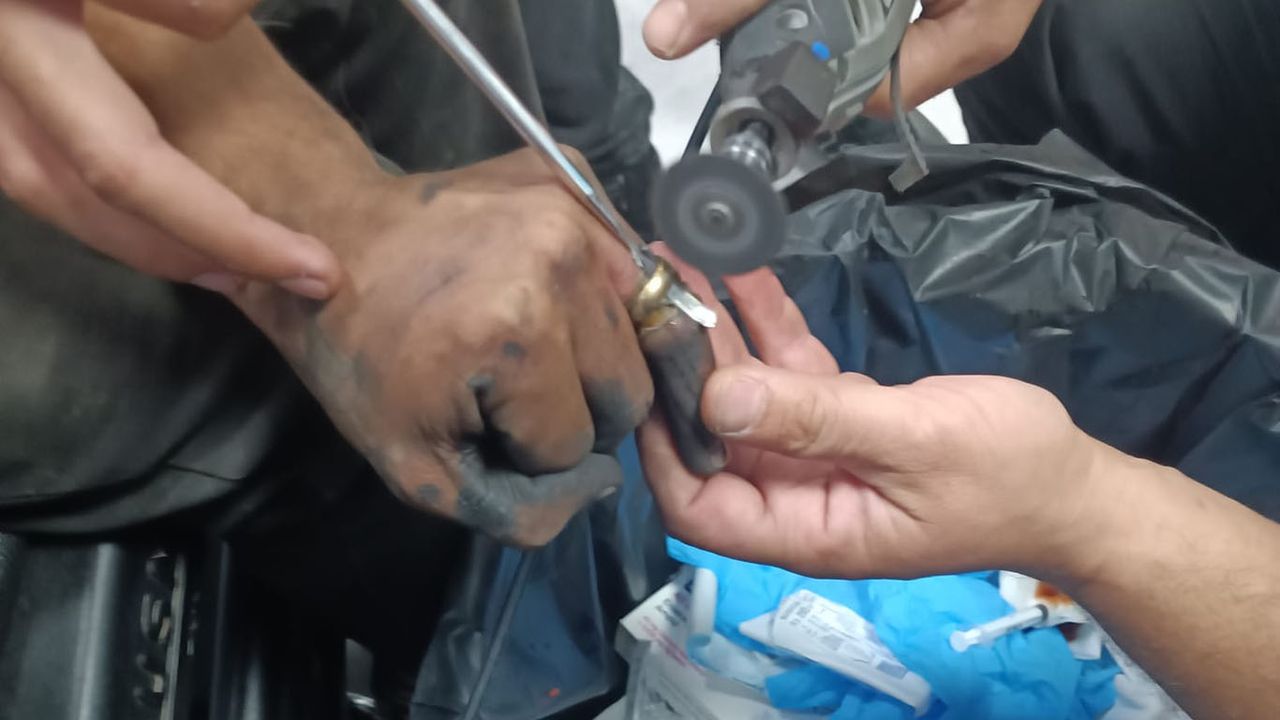 Batman'da parmakta sıkışan yüzük operasyonla çıkarıldı