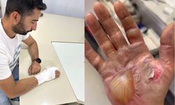 Telefon bataryası patladı tamirci yaralandı