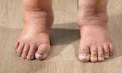 Kollarınızda veya bacaklarınızda şişlik varsa nedeni lenfödem olabilir!