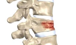 Omurga kırıkları kış aylarında artıyor