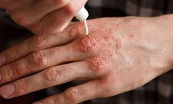 Soğuklarda cilt kuruluğuna karşı 10 tavsiye