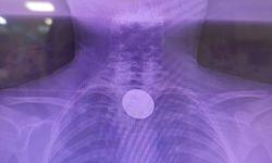 Siirt’te küçük çocuğun yuttuğu madeni para başarılı operasyonla çıkarıldı