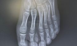 Batman'da nadir 7 parmaklı ayak vakası başarıyla tedavi edildi