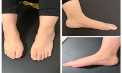 Şanlıurfa’da milyonda bir görülen hastalıkta umut veren başarı