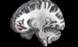 Migrenli beyin 'önemsizi' ayıramıyor, ışık ve desenler ağrıyı tetikliyor