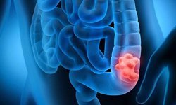 Erken teşhisle kolorektal kanserde başarı oranı yüzde 90'a ulaşıyor