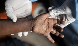 Gana'da maymun çiçeği vakaları bini aştı