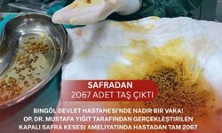 Safra kesesinden 2 bin 67 taş çıktı