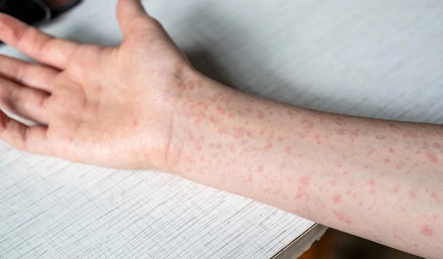 ABD’de kızamık vakaları 33 yılın zirvesinde