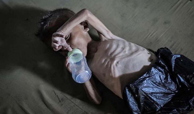 Gazze'de Guillain-Barré salgını ve kitlesel ölüm riski