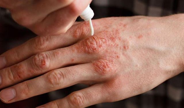 Soğuklarda cilt kuruluğuna karşı 10 tavsiye