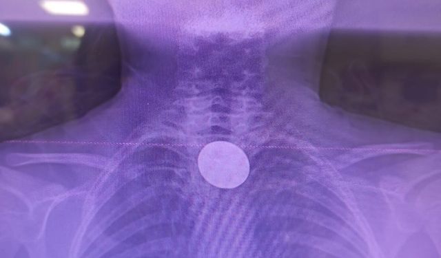 Siirt’te küçük çocuğun yuttuğu madeni para başarılı operasyonla çıkarıldı