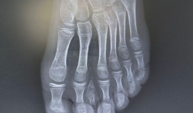 Batman'da nadir 7 parmaklı ayak vakası başarıyla tedavi edildi