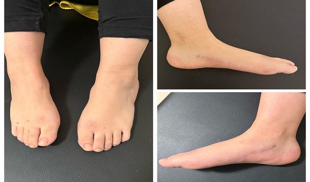 Şanlıurfa’da milyonda bir görülen hastalıkta umut veren başarı