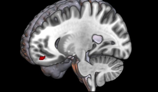 Migrenli beyin 'önemsizi' ayıramıyor, ışık ve desenler ağrıyı tetikliyor