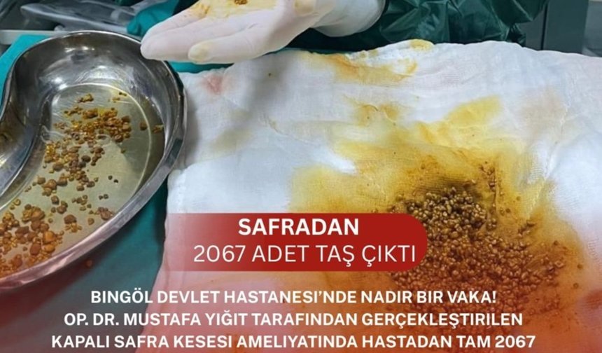 Safra kesesinden 2 bin 67 taş çıktı